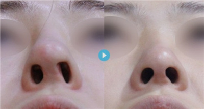 隆鼻修复前后对比