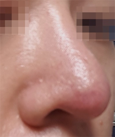 假体隆鼻后鼻头红肿