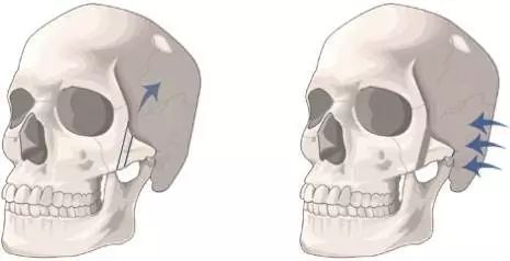 顴骨內推手術風險高嗎?顴骨內推復位是不可能的嗎?