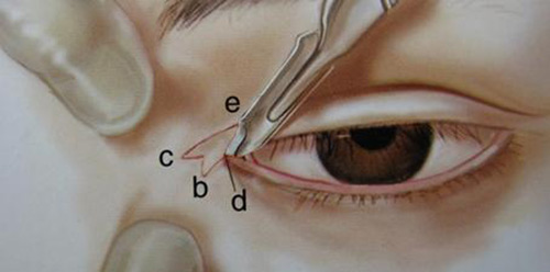 开眼角手术过程示意图