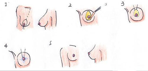 乳房下垂双环乳房悬吊提升过程