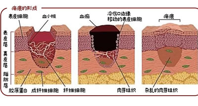 疤痕的形成原因