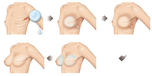 假体植入乳房再造术手术过程