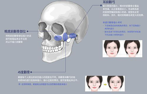 颧骨整形手术示意图