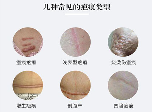 几种常见疤痕类型