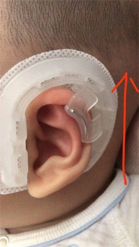 耳廓畸形矫正器