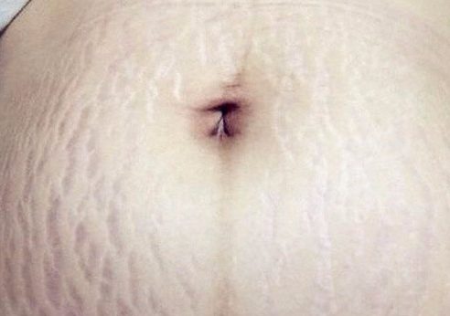 妊娠纹图示