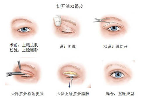 切开法双眼皮