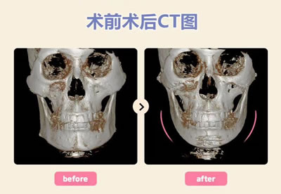 面部轮廓手术CT图