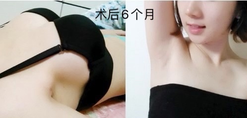 韩国原辰整形隆胸恢复案例