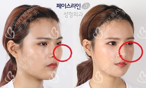 韩国菲斯莱茵整形医院面部轮廓手术对比照片