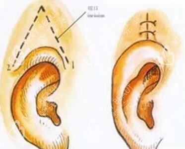 耳整形手术示意图