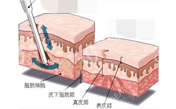 吸脂手术脂肪层对比