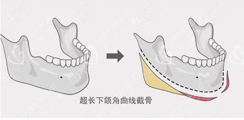 下颌角手术示意图