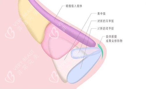 假体隆鼻内部结构
