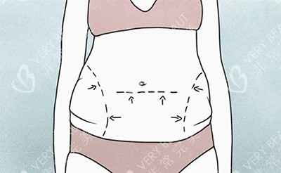 腰腹吸脂改善卡通图展示