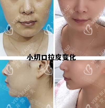 广州王世虎医生做小V脸除皱术变化图