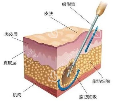 吸脂手术示意图