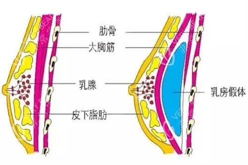 分享当地隆胸技术好的医院