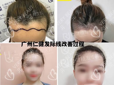 广州仁健植发医院发际线种植过程图