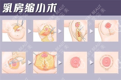 乳房缩小手术过程