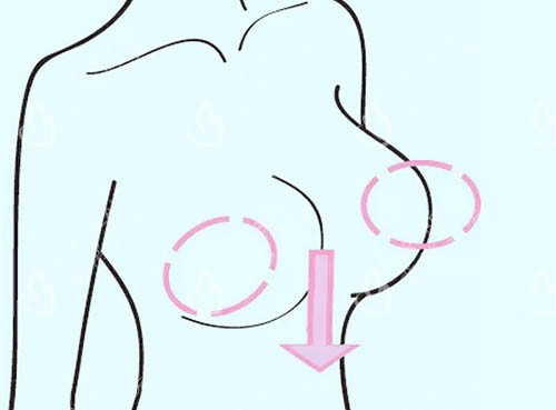 胸整形动画图