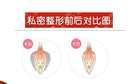 常见的私密整形手术的类型建议姐妹们都了解一下