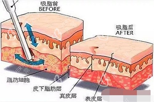 吸脂原理示意图