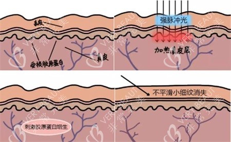 激光缩阴示意图