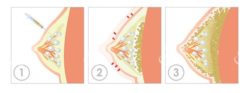 脂肪丰胸示意图图片