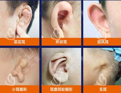 耳朵畸形类型