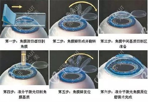 飞秒手术示意图