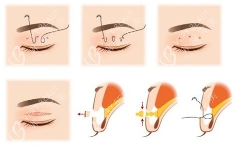 埋线双眼皮的原理图片图片