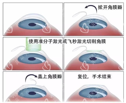 LASIK准分子激光近视手术图