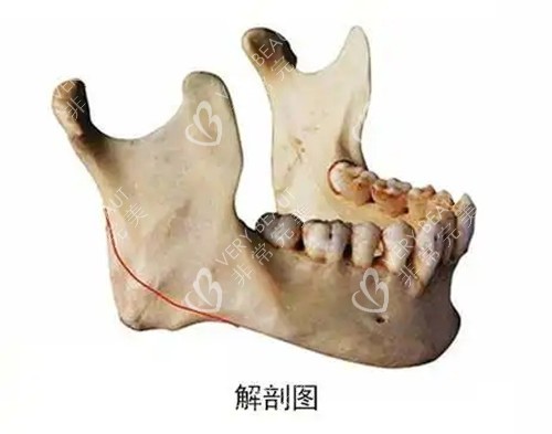 下颌角削骨手术解剖图