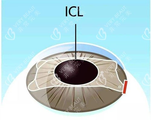 深圳ICL晶体植入手术
