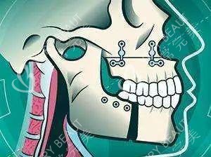 正颌手术漫画透视图