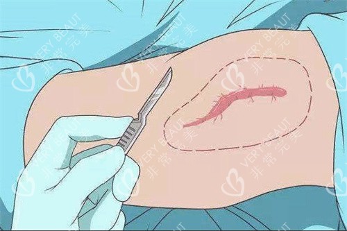 深圳鹏程医院治疗疤痕疙瘩手术法