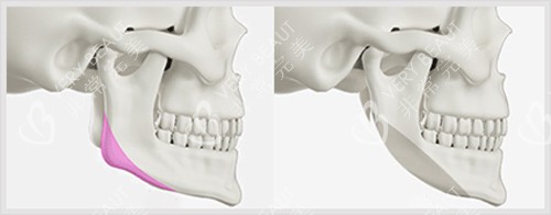 下颌角截骨前后对比