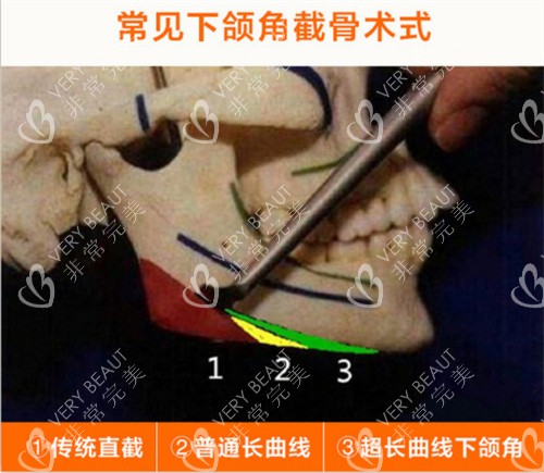 常见下颌角截骨术式