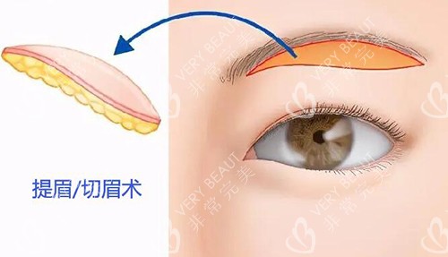 提眉切眉手术卡通图