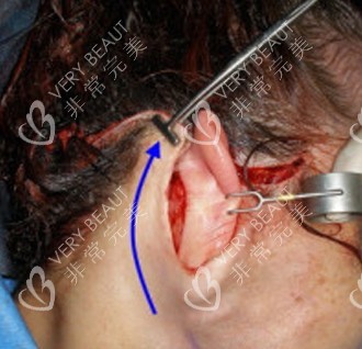 拉皮手术疤痕切口照片