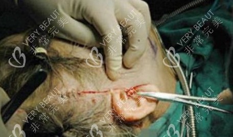 拉皮手术切口缝合照片