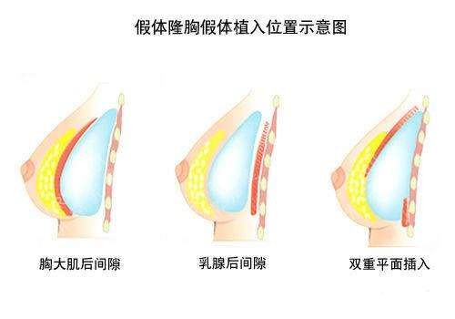 假体隆胸植入位置示意图