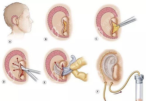 耳畸形手术示意图