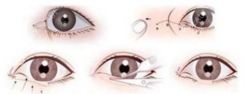 眼睛手术方式动画图