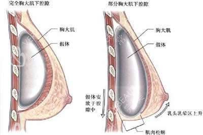 隆胸假体植入层次示意图
