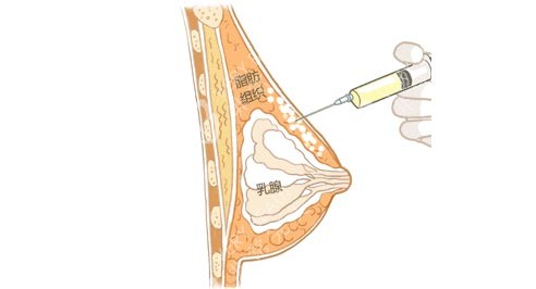 注射丰胸位置示意图