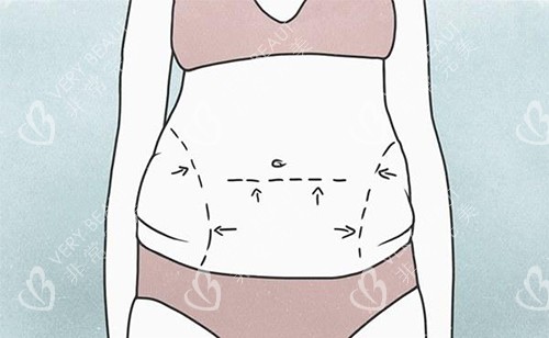 腰腹脂肪堆积漫画图