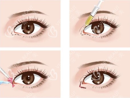 眼睛整形手术动画步骤图